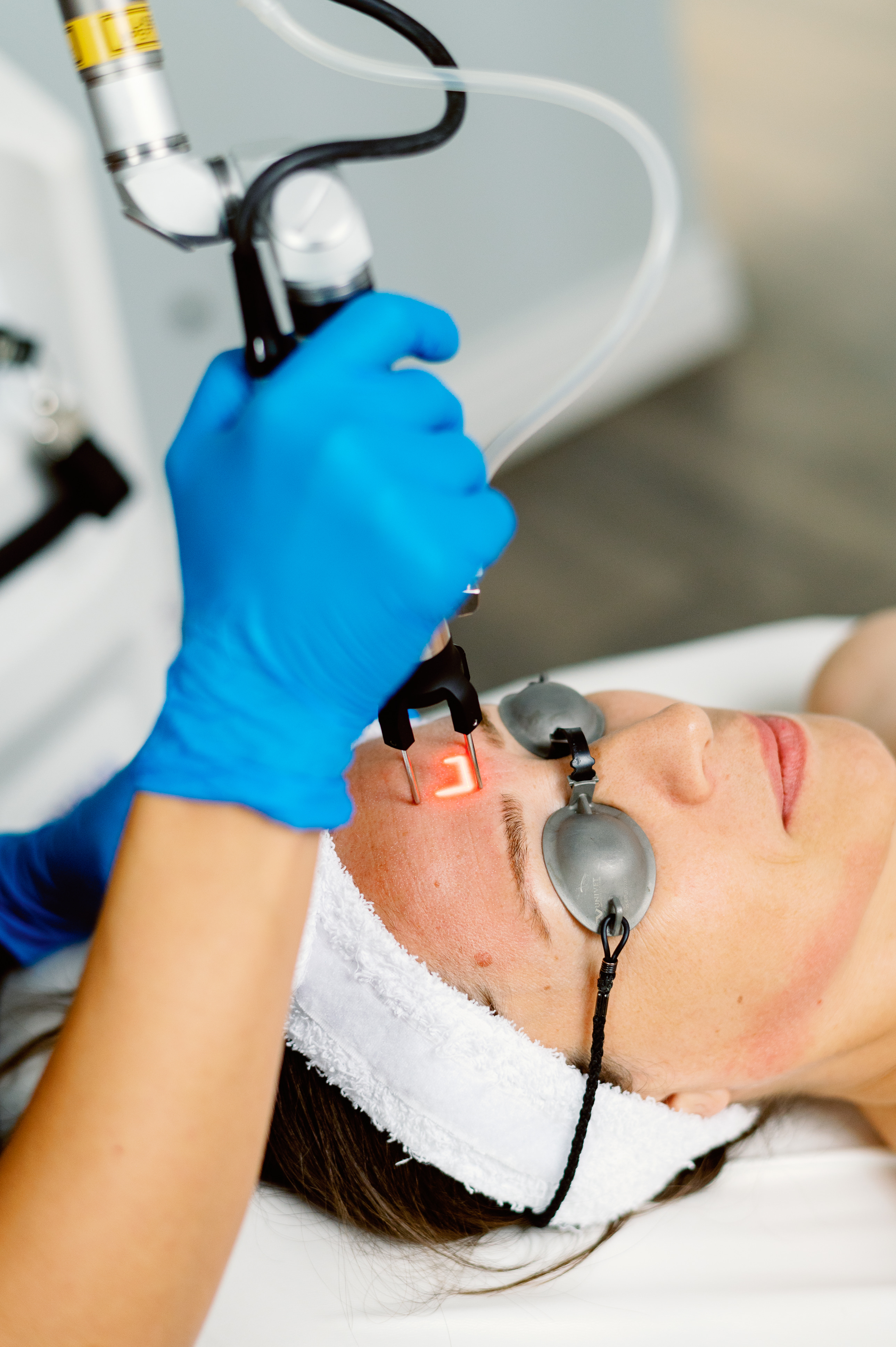 A CoolPeel laser treatment in progress at Waterloo Medical Cosmetics