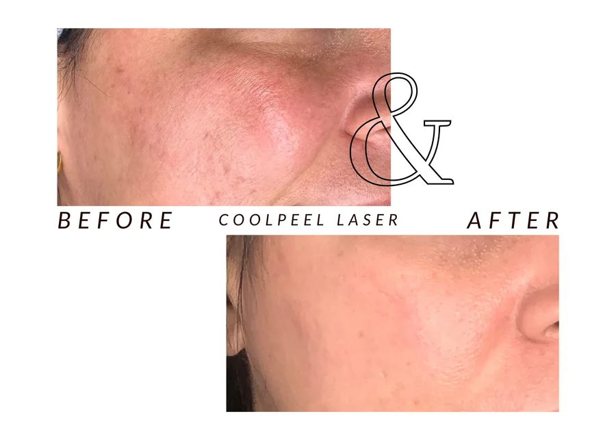 WMC client cheek before (top) and after (bottom) CoolPeel laser treatment