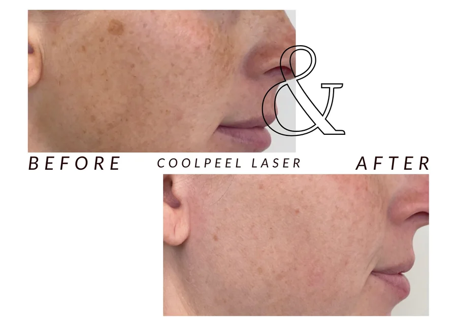 WMC client facial profile before (top) and after (bottom) CoolPeel laser treatment