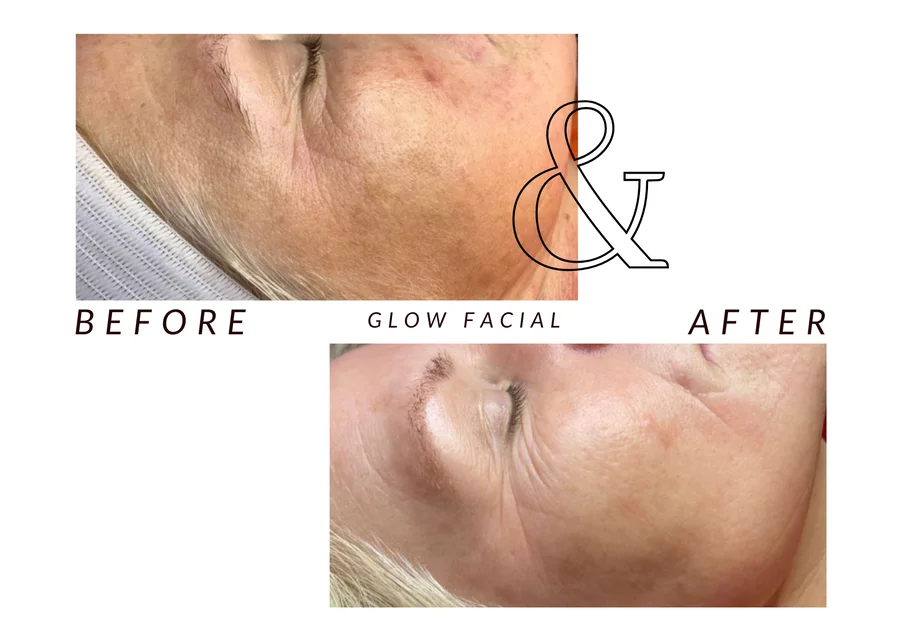 WMC client before and after a glow facial, showing a cheek and jawline