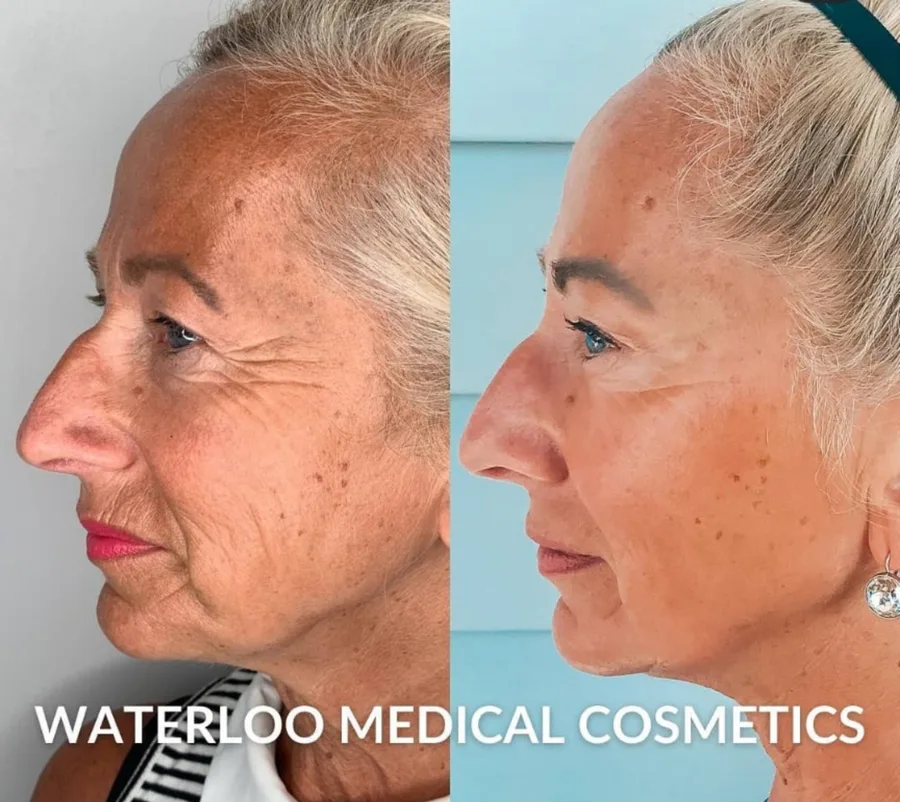 WMC client before and after Facial filler, showing the facial profile in WMC’s facial-filler source set