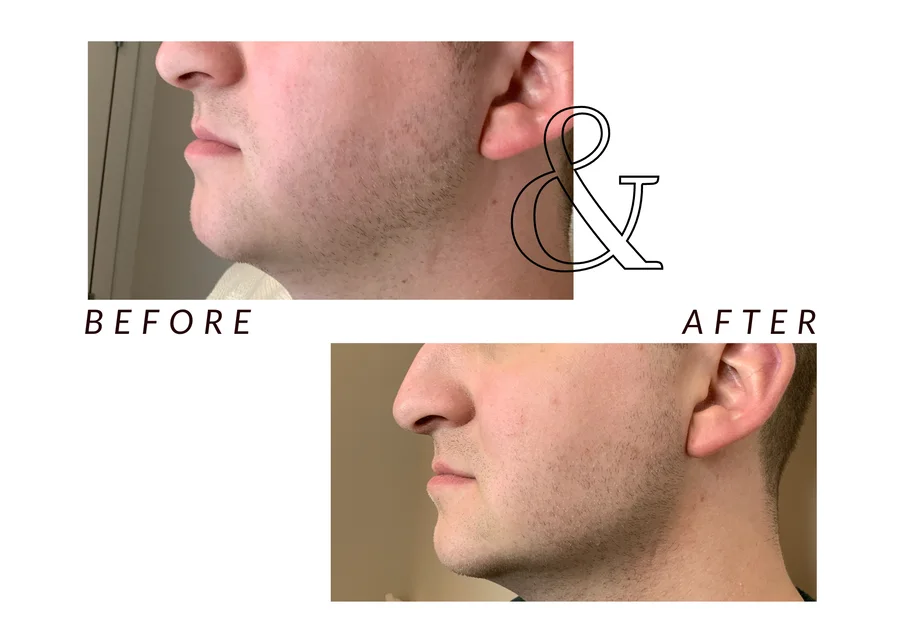 WMC client before and after jawline filler, showing the jawline in profile