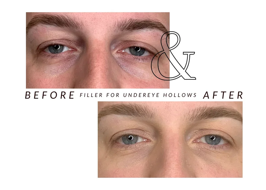 WMC client before and after under-eye filler, showing the under-eye area