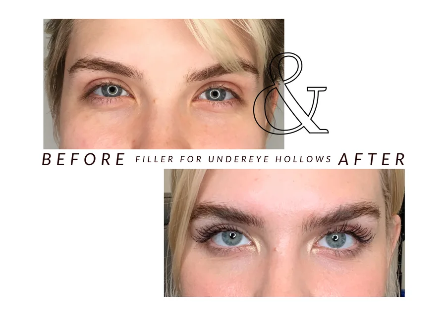 WMC client before and after under-eye filler, showing the under-eye area from the front