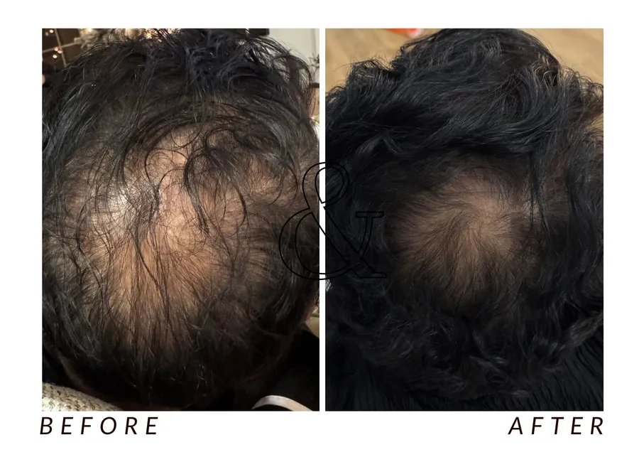 WMC client before and after Hair restoration, showing scalp coverage at the crown