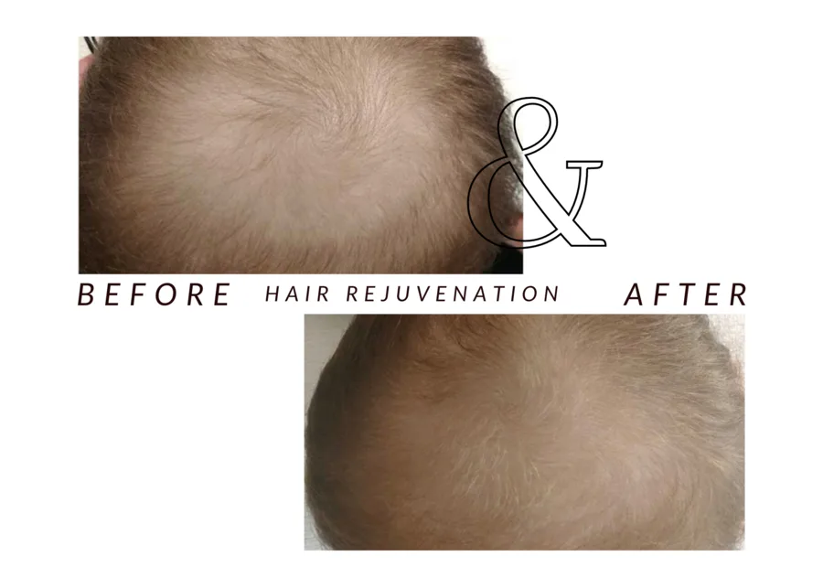 WMC client before and after Hair rejuvenation, showing the scalp before and after hair rejuvenation