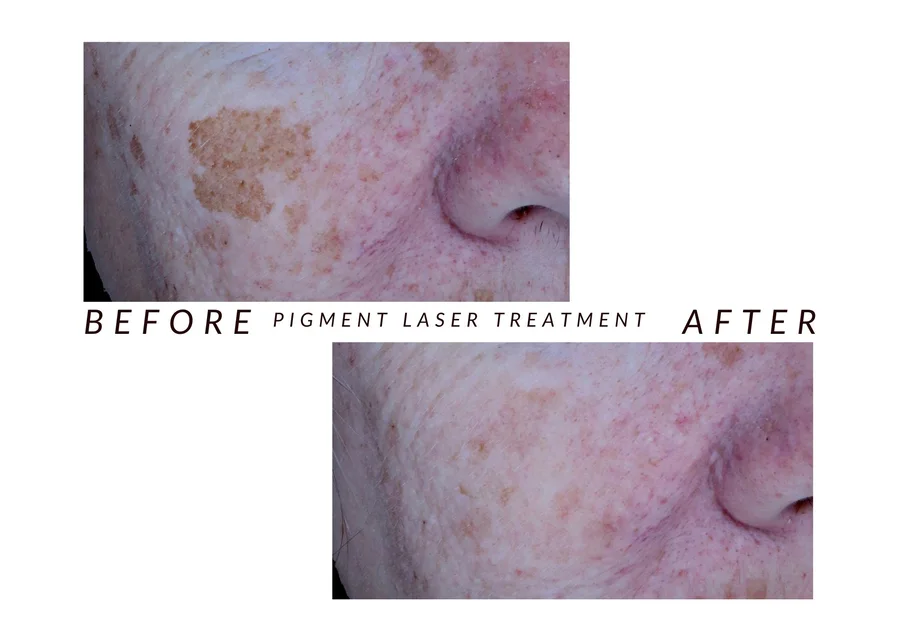 WMC client before and after pigment laser treatment, showing pigmentation on a cheek