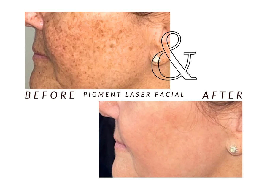WMC client before and after a pigment laser facial, showing pigmentation on a facial profile
