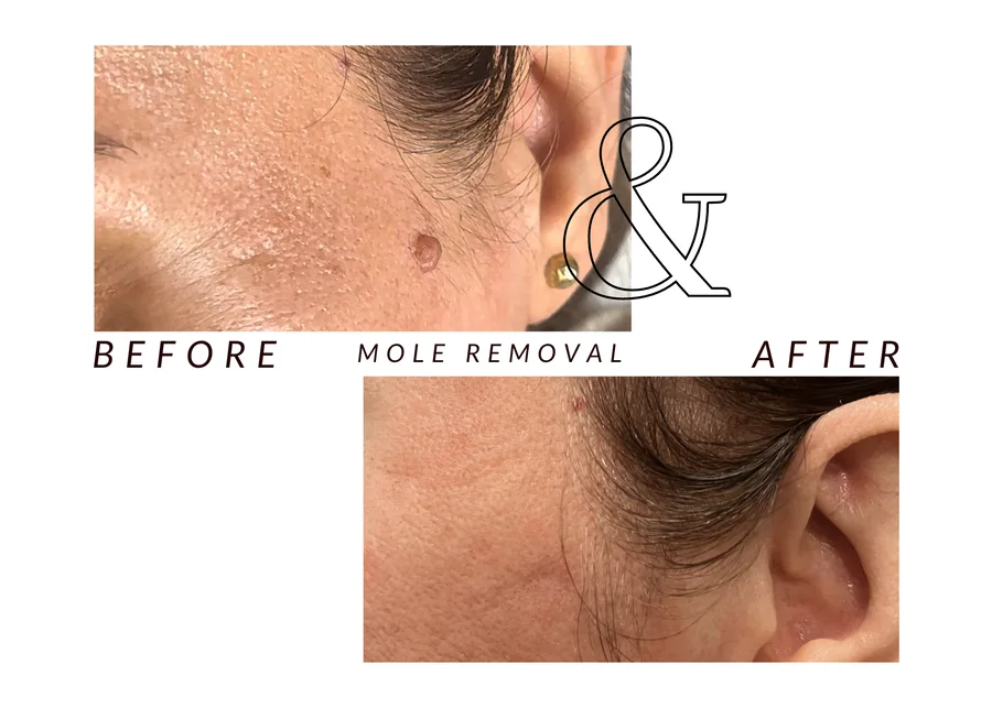WMC client before and after mole removal, showing a mole on the face
