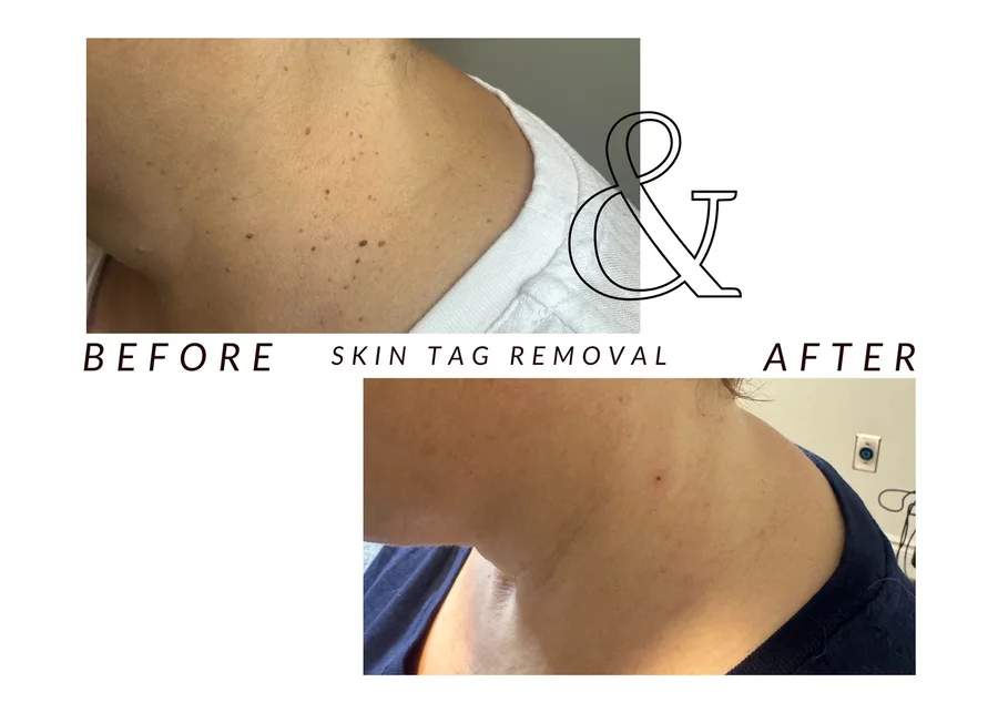 WMC client before and after skin tag removal, showing a skin tag on the neck