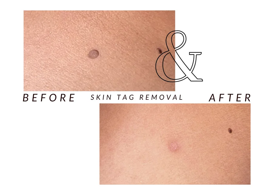 WMC client before and after skin tag removal, showing a skin tag on the skin