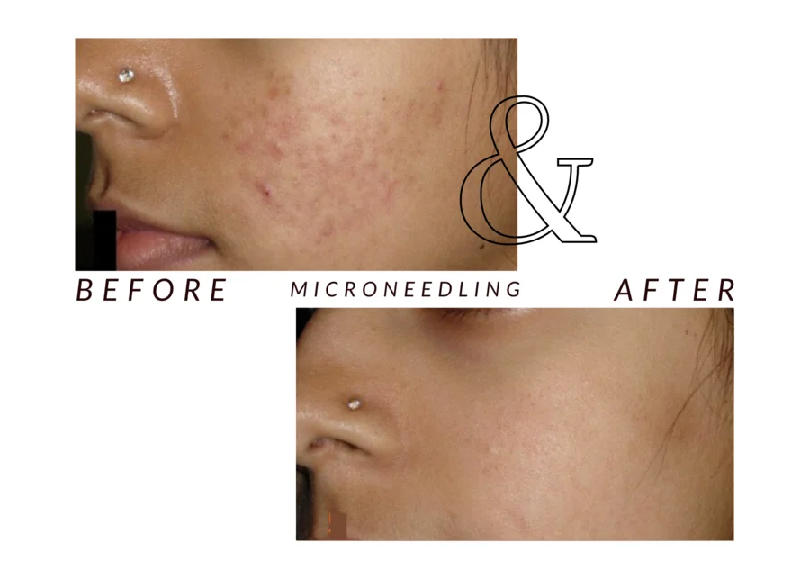 WMC client cheek before (top) and after (bottom) microneedling