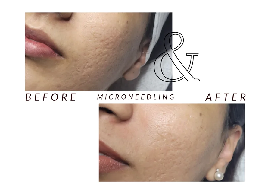 WMC client before and after microneedling, showing the cheek and chin