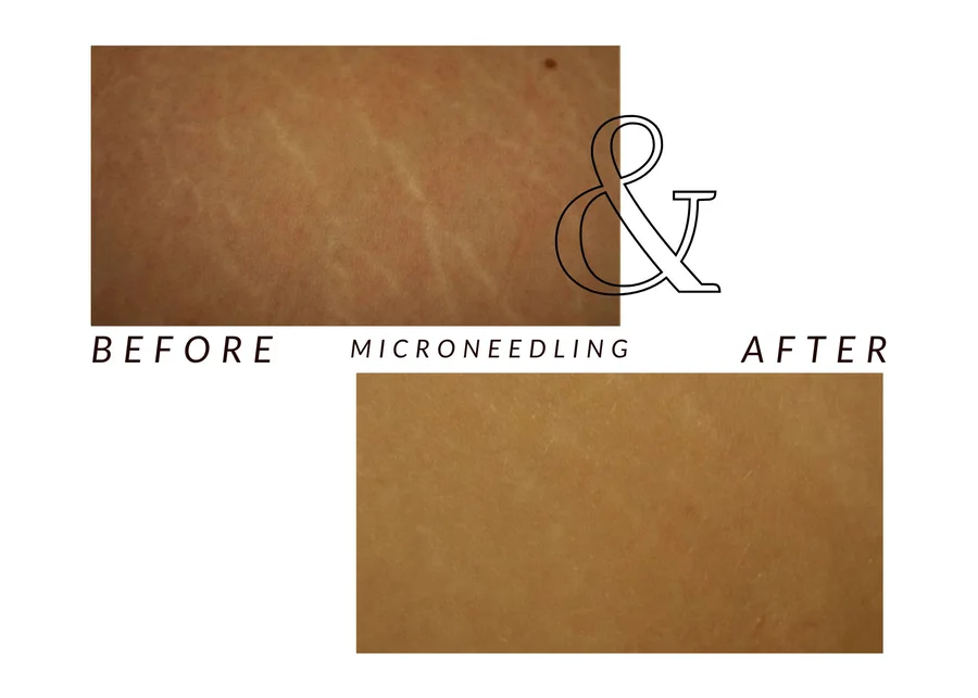 WMC client skin texture before (top) and after (bottom) microneedling