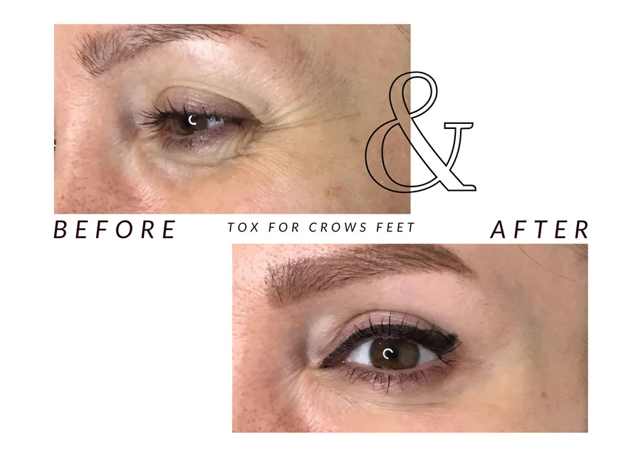WMC client before and after cosmetic tox for crow’s feet, showing lines around an eye