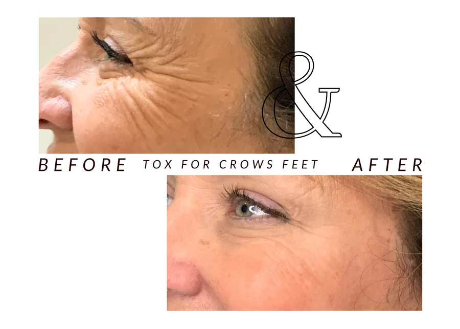 WMC client before and after cosmetic tox for crow’s feet, showing lines around an eye in profile