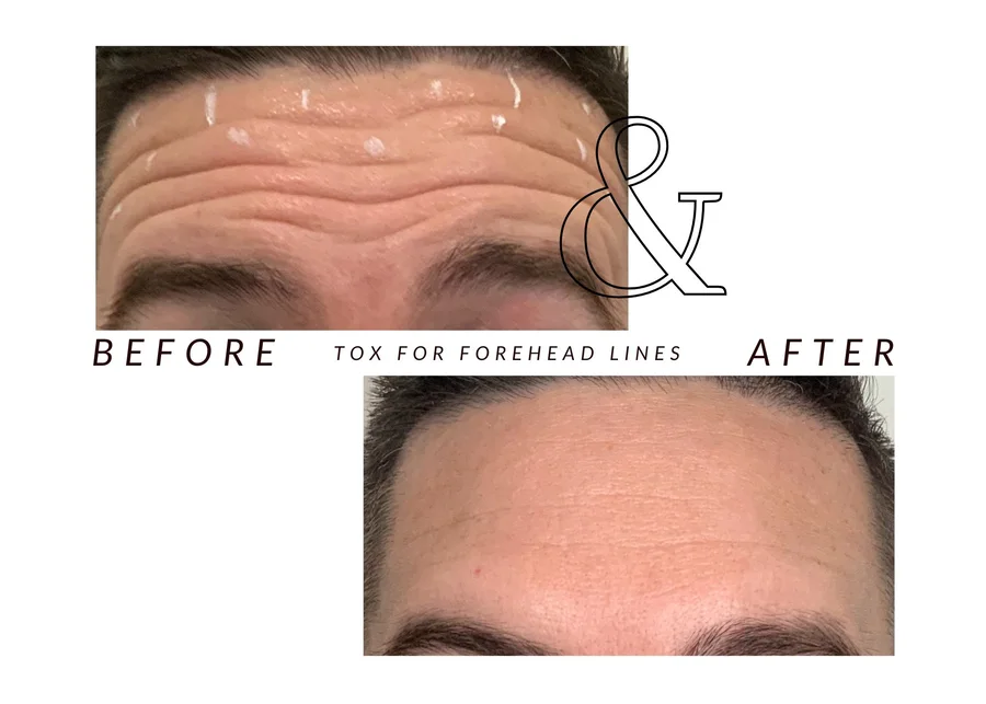 WMC client before and after cosmetic tox for forehead lines, showing forehead lines from the front