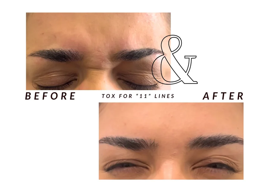 WMC client before and after cosmetic tox for 11 lines, showing the brow and frown lines